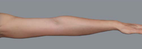Arm Laxity Scale Grade 1