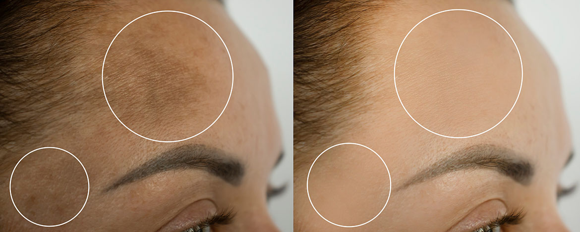 Pigmentation before and after treatment